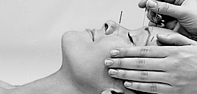 Cosmetic Acupuncture